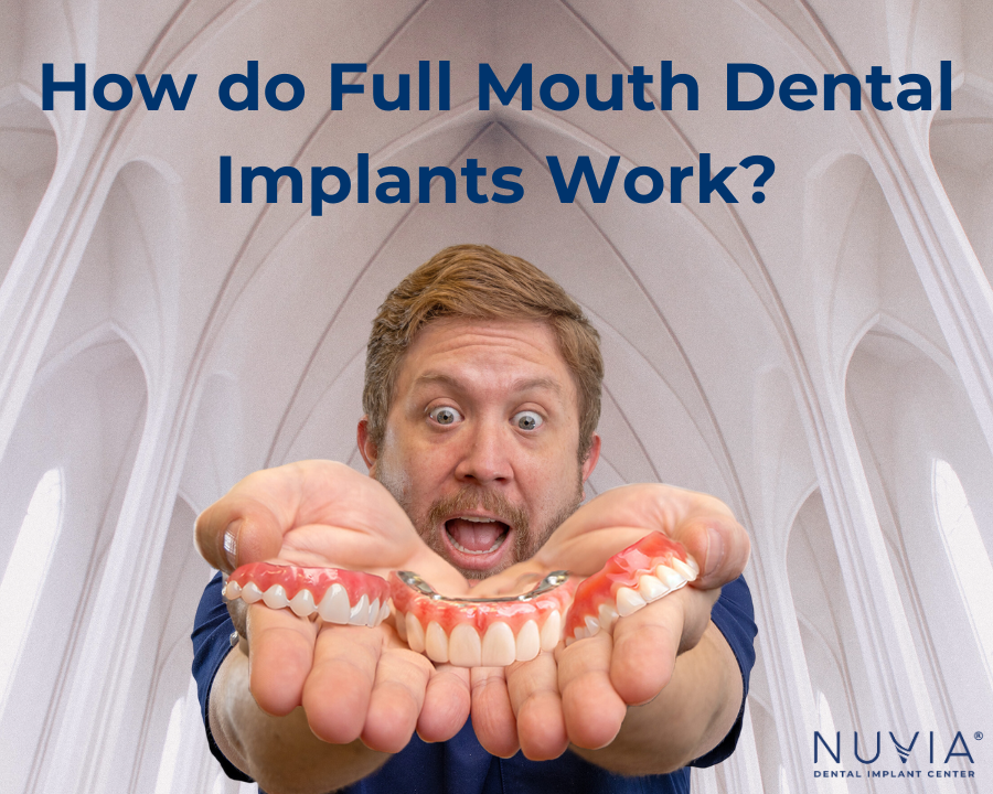 Unlocking the Mystery How Do Full Mouth Dental Implants Work?